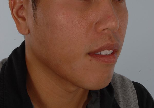 Chin Narrowing Case 1658 Before Photo Chin Narrowing