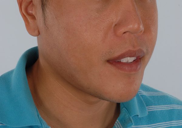 Chin Narrowing Case 1658 After Photo Chin Narrowing