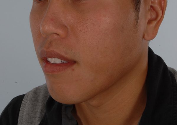 Chin Narrowing Case 1658 Before Photo Chin Narrowing