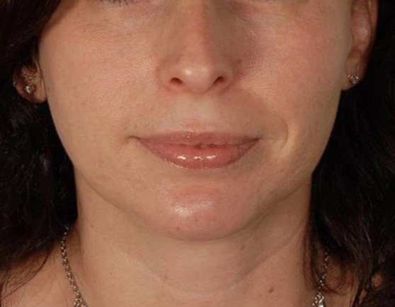 Perioral Rejuvenation Case 1674 After Photo Perioral Rejuvenation