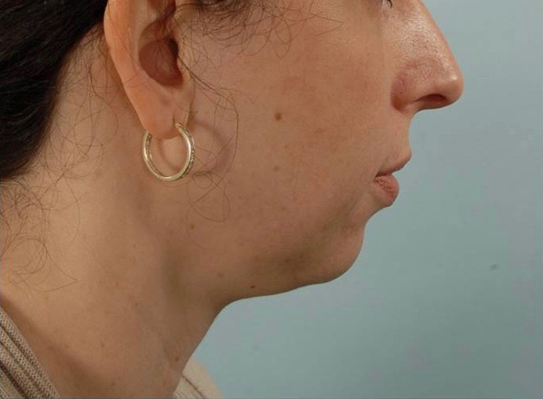 Perioral Rejuvenation Case 1674 Before Photo Perioral Rejuvenation