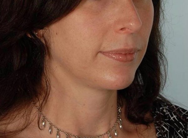 Perioral Rejuvenation Case 1674 After Photo Perioral Rejuvenation