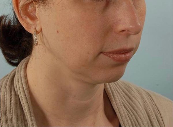 Perioral Rejuvenation Case 1674 Before Photo Perioral Rejuvenation