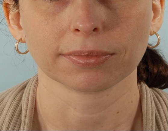 Perioral Rejuvenation Case 1674 Before Photo Perioral Rejuvenation