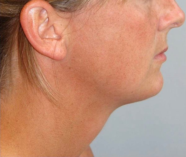 Perioral Rejuvenation Case 1682 After Photo Perioral Rejuvenation
