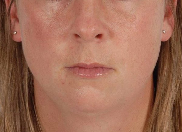 Perioral Rejuvenation Case 1682 Before Photo Perioral Rejuvenation