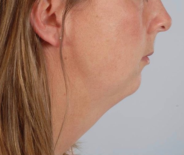 Perioral Rejuvenation Case 1682 Before Photo Perioral Rejuvenation