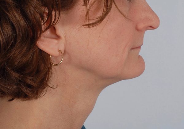Perioral Rejuvenation Case 1688 Before Photo Perioral Rejuvenation