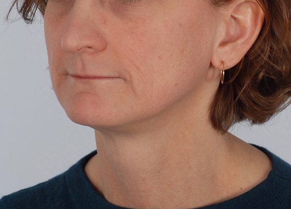 Perioral Rejuvenation Case 1688 Before Photo Perioral Rejuvenation