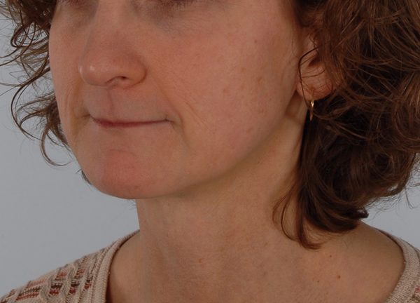 Perioral Rejuvenation Case 1688 After Photo Perioral Rejuvenation