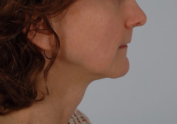 Perioral Rejuvenation Case 1688 After Photo Perioral Rejuvenation
