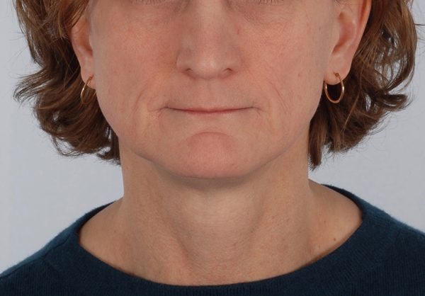 Perioral Rejuvenation Case 1688 Before Photo Perioral Rejuvenation