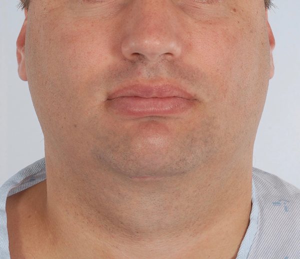 Perioral Rejuvenation Case 1698 After Photo Perioral Rejuvenation