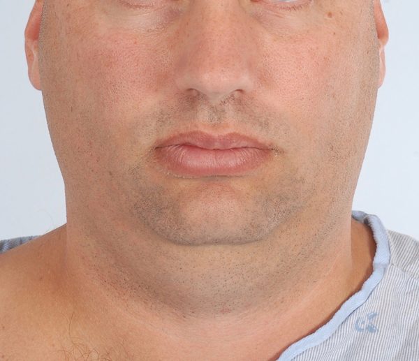 Perioral Rejuvenation Case 1698 Before Photo Perioral Rejuvenation