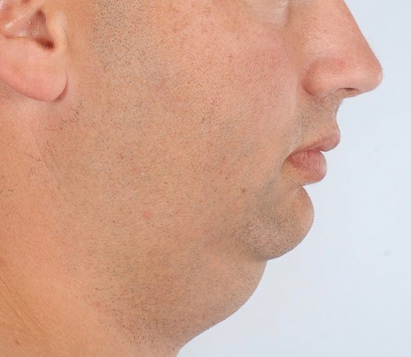 Perioral Rejuvenation Case 1698 Before Photo Perioral Rejuvenation
