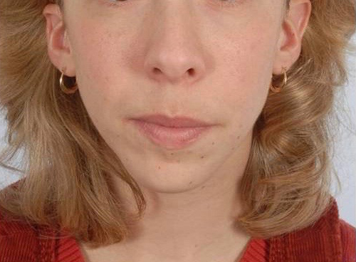 Perioral Rejuvenation Case 1704 After Photo Perioral Rejuvenation