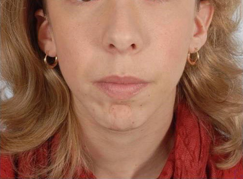 Perioral Rejuvenation Case 1704 Before Photo Perioral Rejuvenation