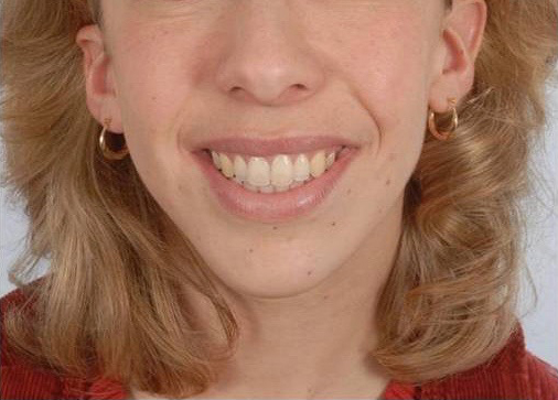 Perioral Rejuvenation Case 1704 After Photo Perioral Rejuvenation