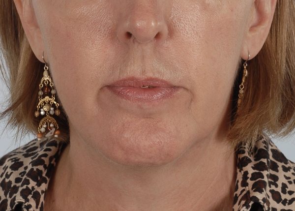 Perioral Rejuvenation Case 1710 After Photo Perioral Rejuvenation