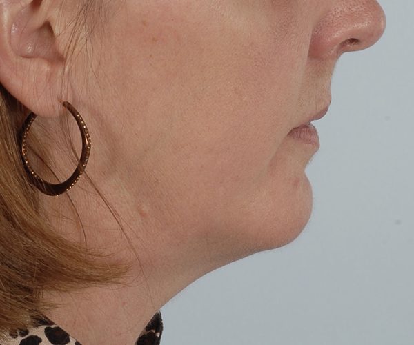 Perioral Rejuvenation Case 1710 After Photo Perioral Rejuvenation