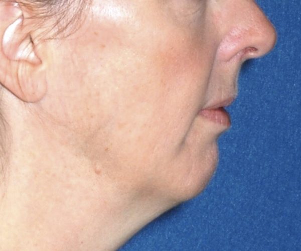 Perioral Rejuvenation Case 1710 Before Photo Perioral Rejuvenation