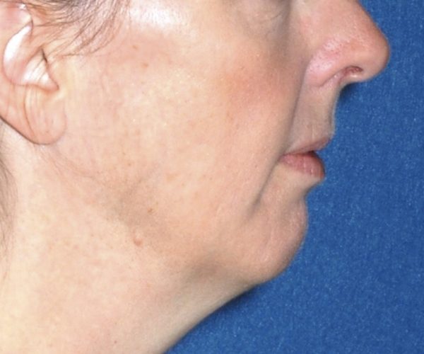 Perioral Rejuvenation