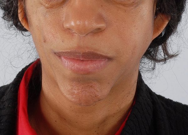Syndromic Case 1720 After Photo Syndromic
