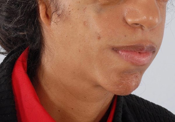 Syndromic Case 1720 After Photo Syndromic