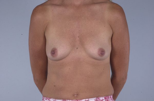 Breast Augmentation Case 1759 Before Photo Breast Augmentation