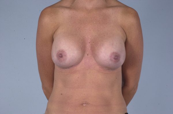 Breast Augmentation Case 1759 After Photo Breast Augmentation