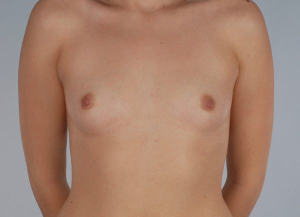 Breast Augmentation