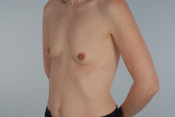 Breast Augmentation Case 1801 Before Photo Breast Augmentation