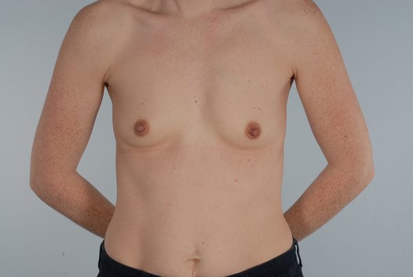 Breast Augmentation Case 1801 Before Photo Breast Augmentation