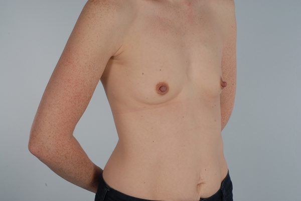 Breast Augmentation Case 1801 Before Photo Breast Augmentation