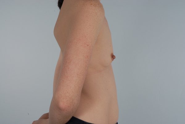 Breast Augmentation Case 1801 Before Photo Breast Augmentation