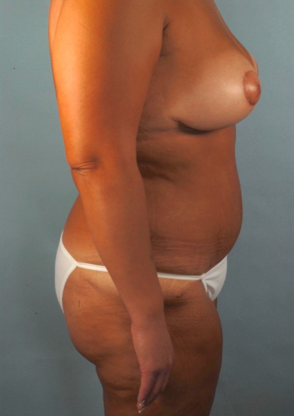 Abdominoplasty (Tummy Tuck) with Breast Reduction/Lift