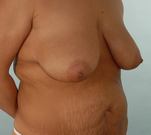 Abdominoplasty (Tummy Tuck) with Breast Reduction/Lift