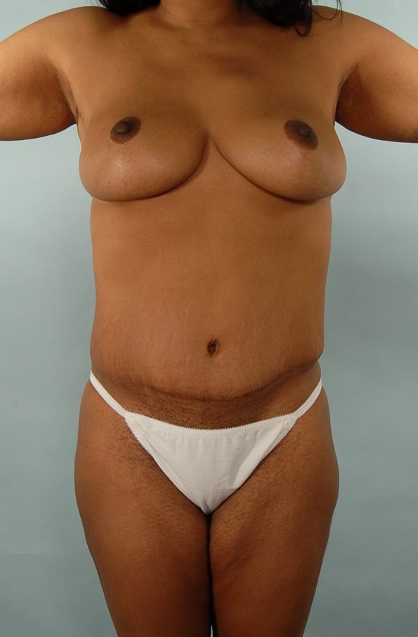 Abdominoplasty (Tummy Tuck) with Breast Reduction/Lift