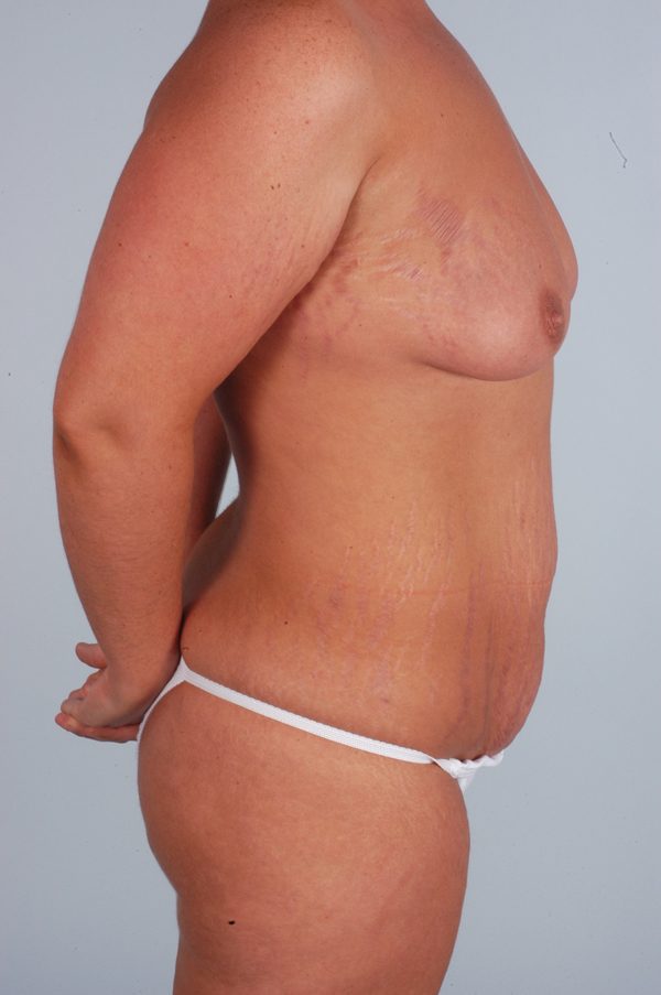 Abdominoplasty (Tummy Tuck) with Breast Augmentation Case 1899 Before Photo Abdominoplasty (Tummy Tuck) with Breast Augmentation
