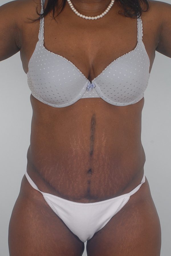 Abdominoplasty (Tummy Tuck) Case 1900 After Photo Abdominoplasty (Tummy Tuck)