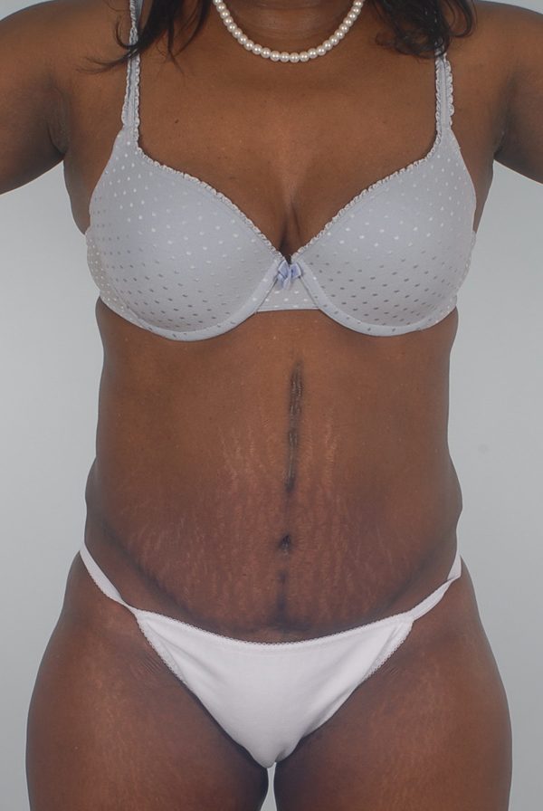 Abdominoplasty (Tummy Tuck)