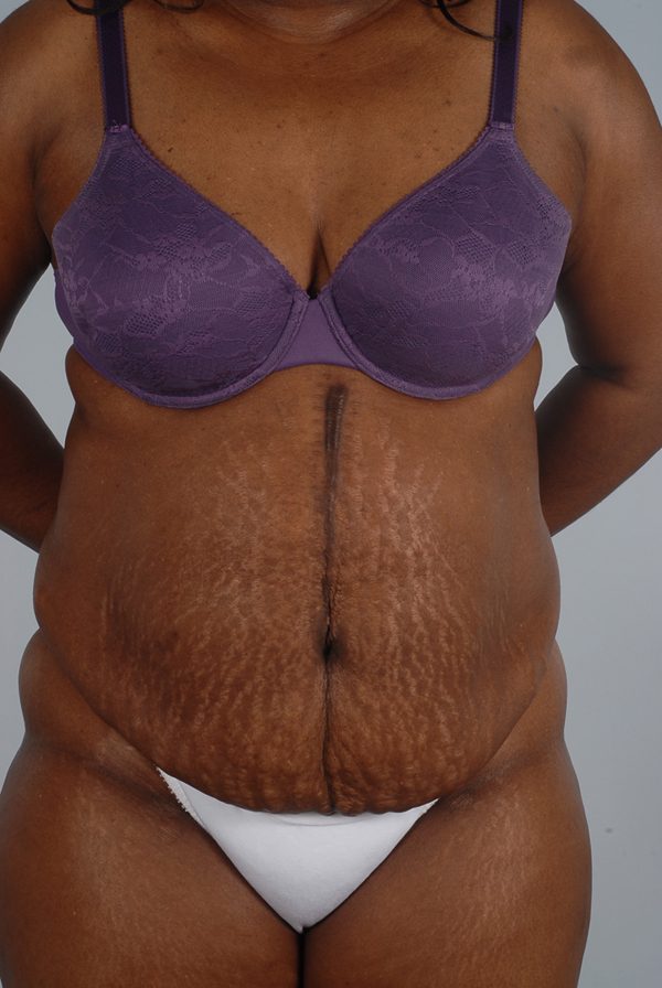 Abdominoplasty (Tummy Tuck) Case 1900 Before Photo Abdominoplasty (Tummy Tuck)