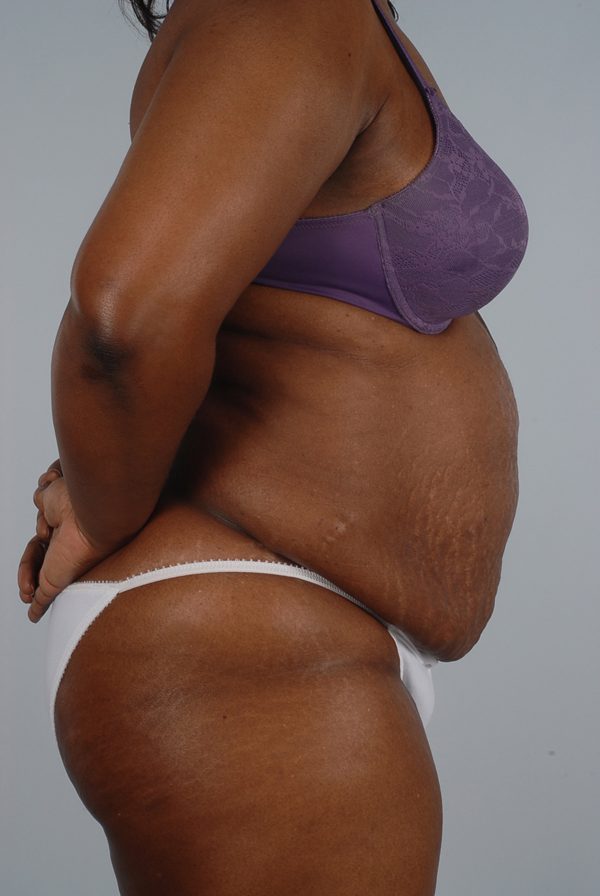 Abdominoplasty (Tummy Tuck) Case 1900 Before Photo Abdominoplasty (Tummy Tuck)