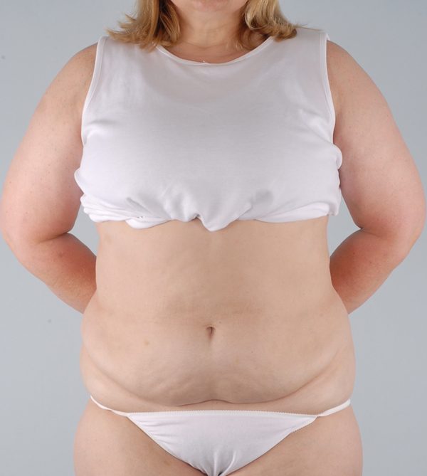 Abdominoplasty (Tummy Tuck) Case 1901 Before Photo Abdominoplasty (Tummy Tuck)