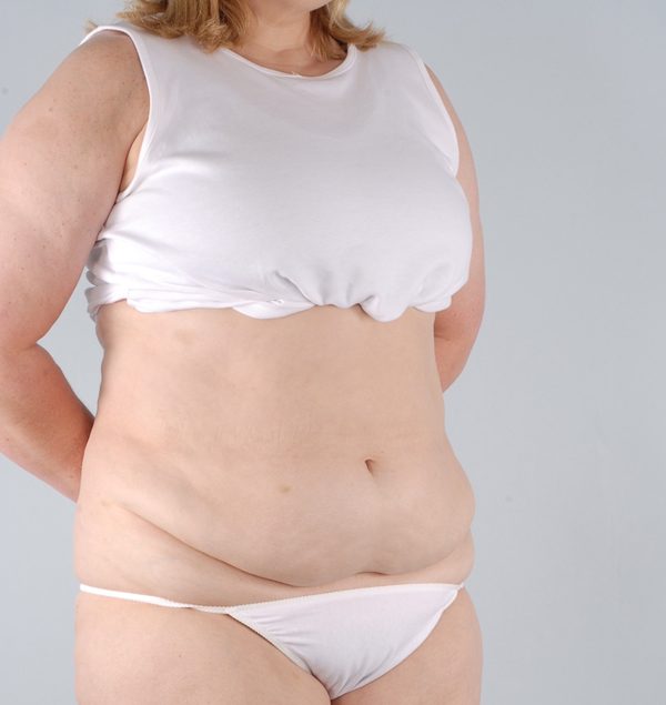 Abdominoplasty (Tummy Tuck) Case 1901 Before Photo Abdominoplasty (Tummy Tuck)