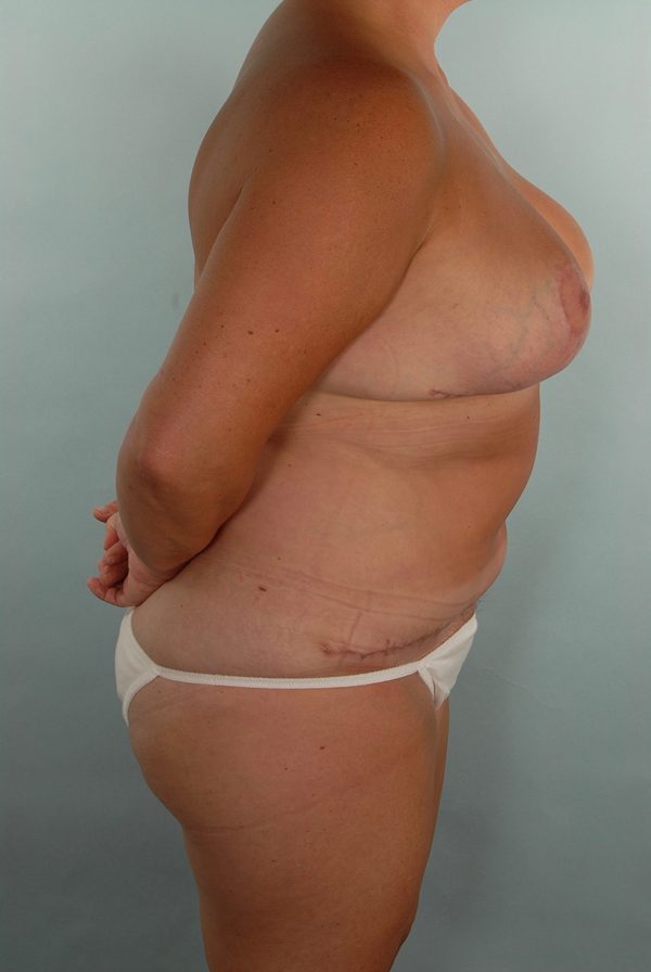 Abdominoplasty (Tummy Tuck) with Breast Reduction/Lift