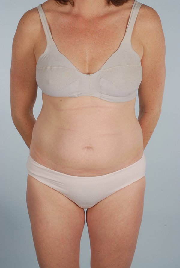 Abdominoplasty (Tummy Tuck) Case 1937 Before Photo Abdominoplasty (Tummy Tuck)