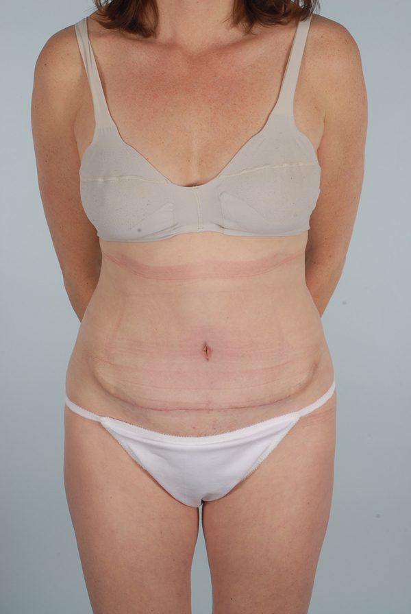 Abdominoplasty (Tummy Tuck) Case 1937 After Photo Abdominoplasty (Tummy Tuck)