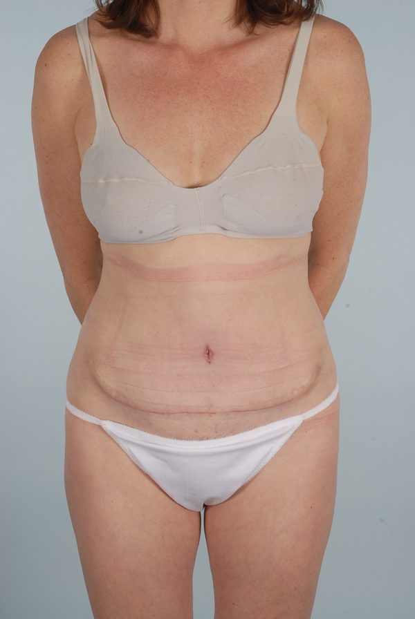 Abdominoplasty (Tummy Tuck)