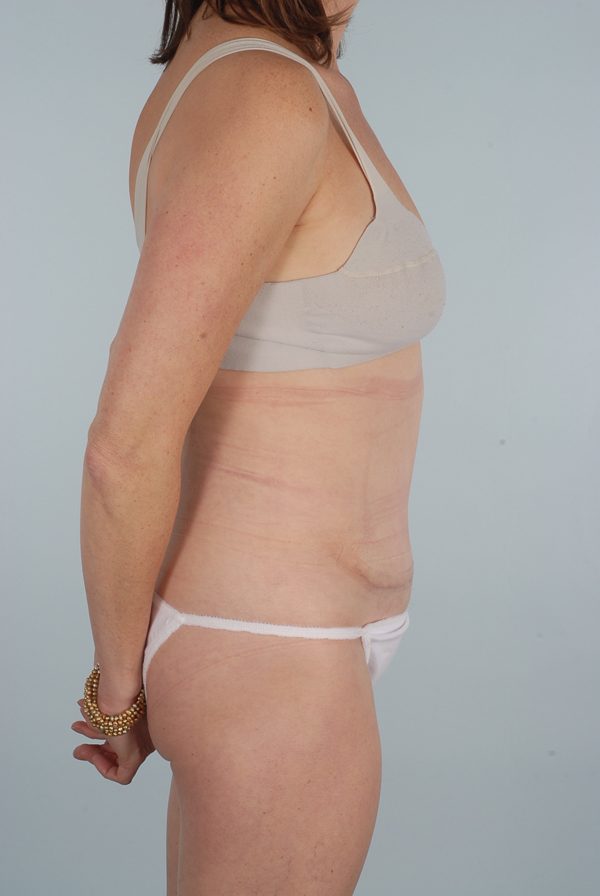 Abdominoplasty (Tummy Tuck)